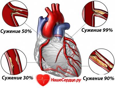 Ишемия сердца