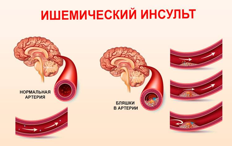 Инсульт Ишемический инсульт