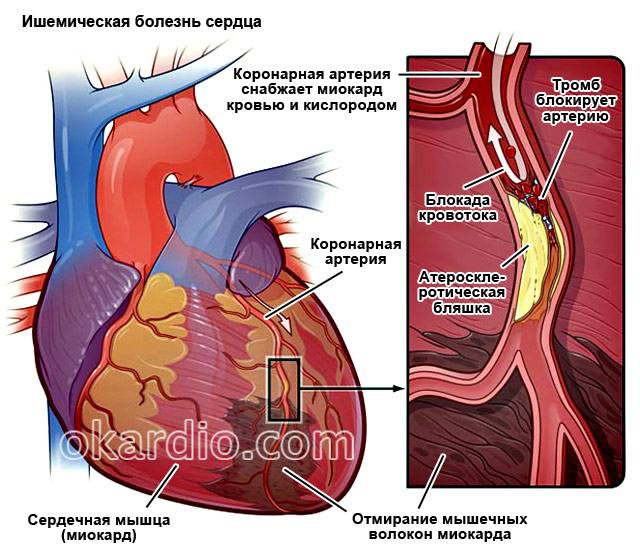 ишемическая болезнь сердца