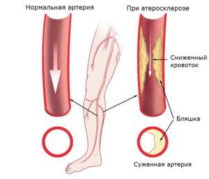 Облитерирующий атеросклероз сосудов нижних конечностей