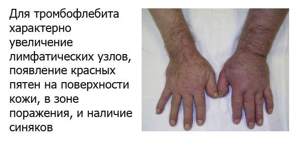 Симптомы тромбофлебита верхних конечностей