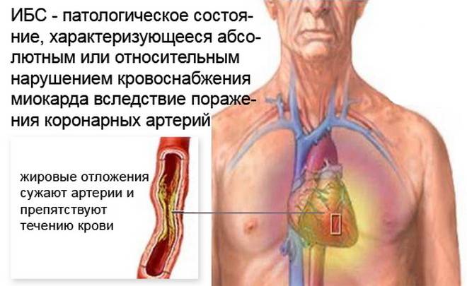 Ишемическая болезнь сердца