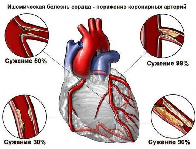 ИБС