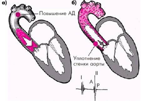 Анатомическое уплотнение стенок аорты сердца Симптомы проявления