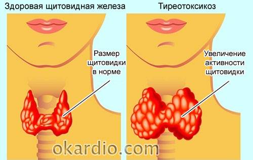 тиреотоксикоз