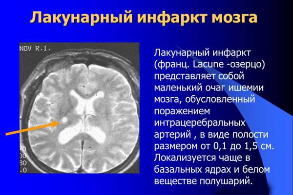 Определение лакунарного инфаркта