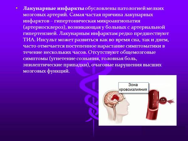Лакунарный инфаркт