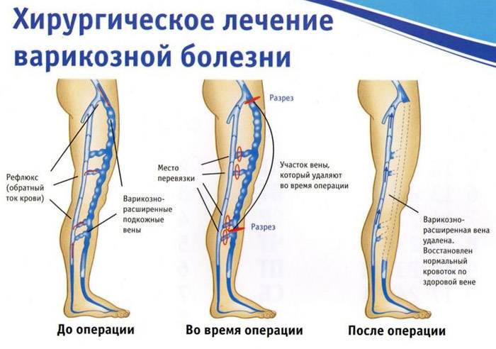 Что такое флебэктомия