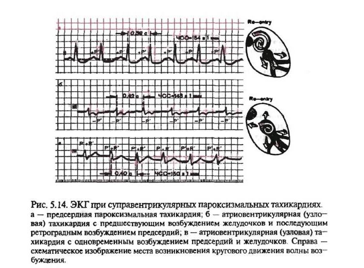 Признаки заболевания на ЭКГ