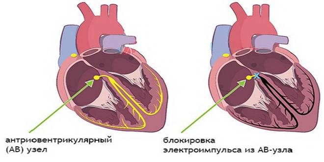 Блокады сердца