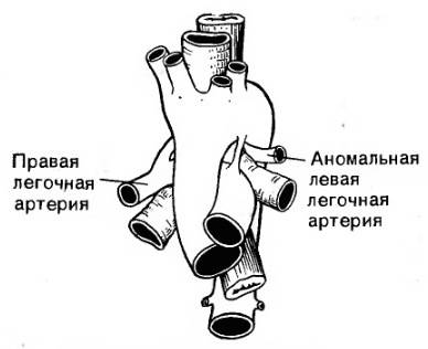 Аномальная левая легочная артерия: сосудистая петля. Артерия, идущая к левому легкому, отходит от правой легочной артерии (модификация по Stewart, Kincaid, Edwards, 1964)