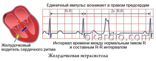 желудочковая экстрасистола на ЭКГ