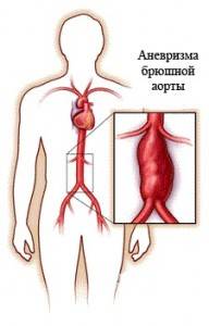 Фиброз створок аортального клапана что это такое