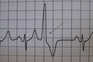 желудочковая экстрасистолия экг