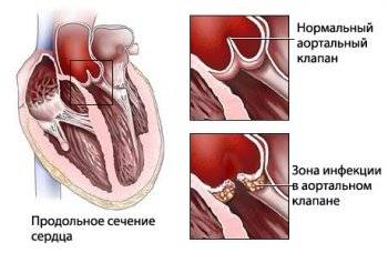 Эндокардит это