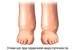 Особенности отеков при сердечной недостаточности