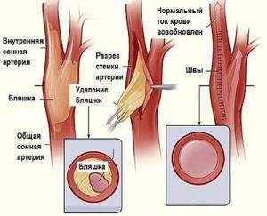 Нестенозирующий атеросклероз