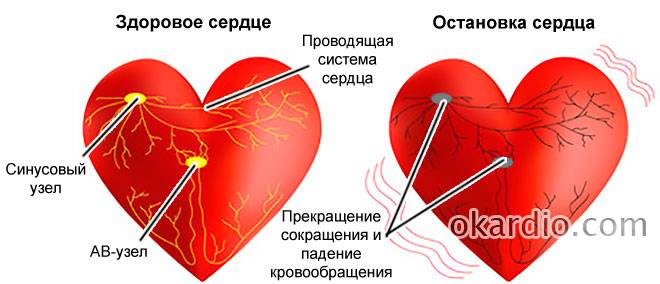 остановка сердца