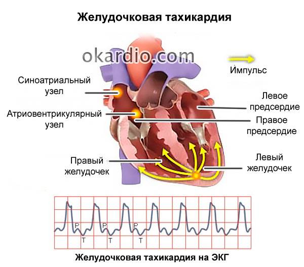 желудочковая тахикардия
