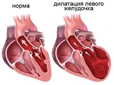 дилатация левого желудочка сердца дилатация левого желудочка сердца