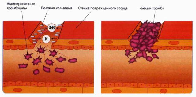 белые тромбы