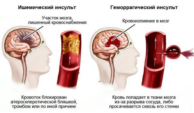 Виды инсульта