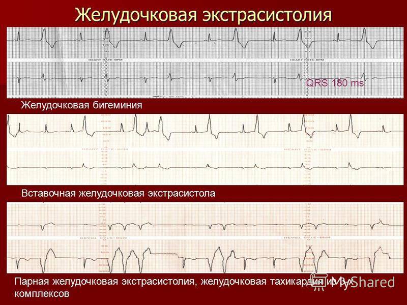 Желудочковая экстрасистолия Желудочковая экстрасистолия