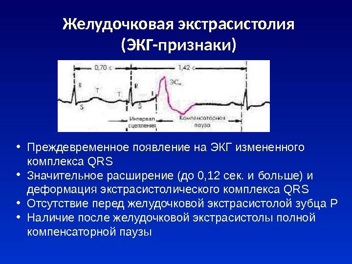 Желудочковая экстрасистолия ЭКГ признаки Желудочковая экстрасистолия ЭКГ признаки
