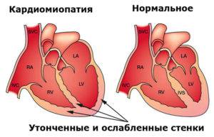 Алкогольная кардимиопатия