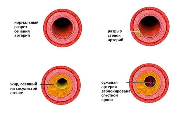 Срезы артерий с холестерином на стенках
