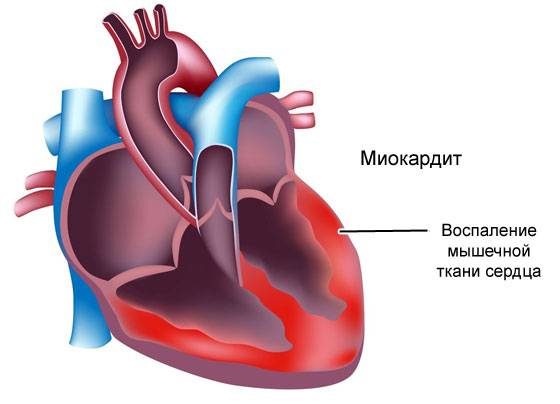миокардит