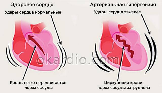 гипертензия
