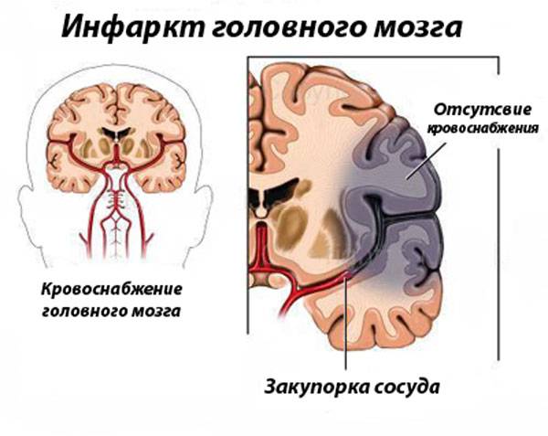 Инфаркт головного мозга