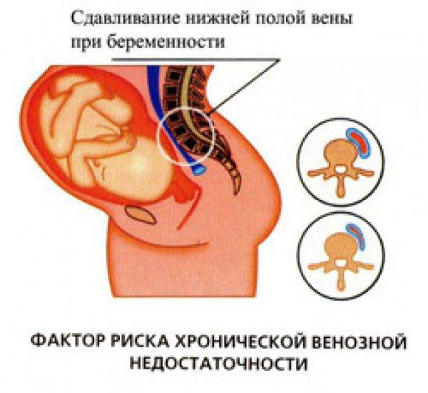 Сдавливание нижней полой вены при беременности