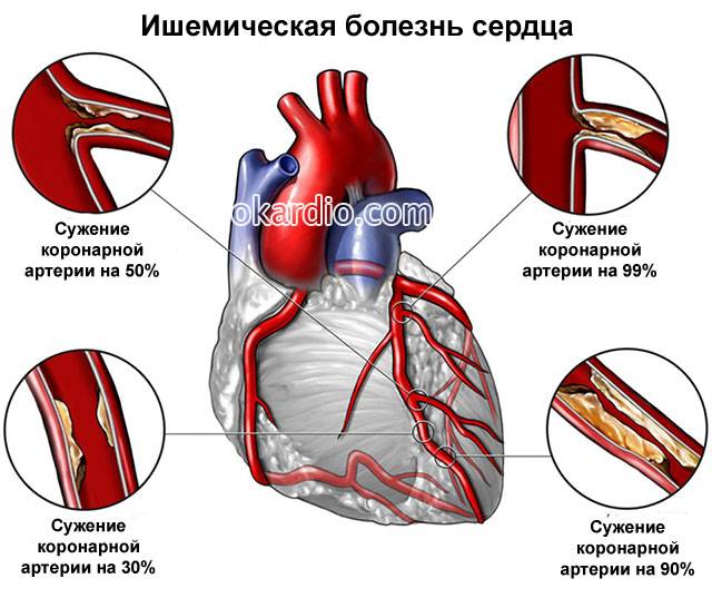 ишемическая болезнь сердца