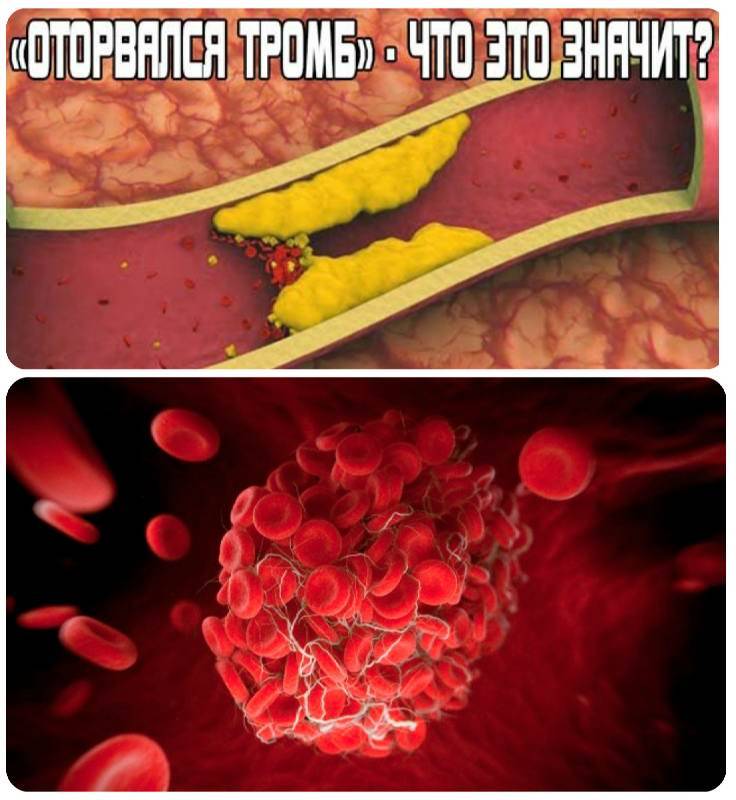 Почему отрывается тромб