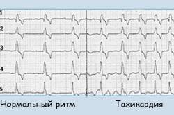 Сердечные ритмы при тахикардии