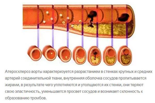 Атеросклероз аорты