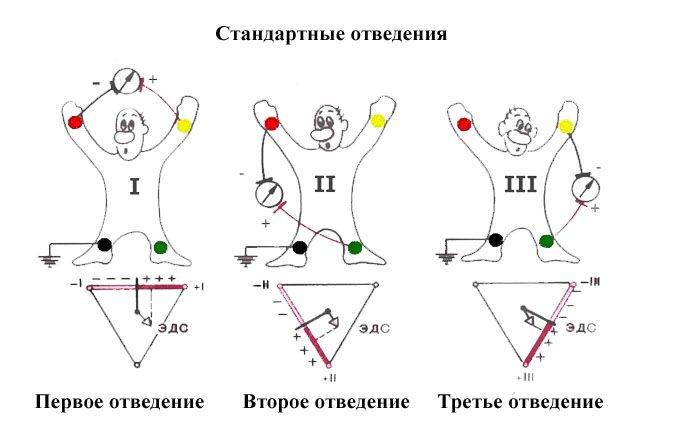 Снятие экг наложение электродов