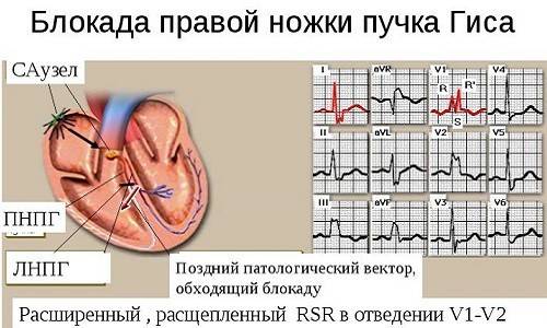 Блокада правой ножки пучка Гиса