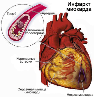 Развитие инфаркта миокарда