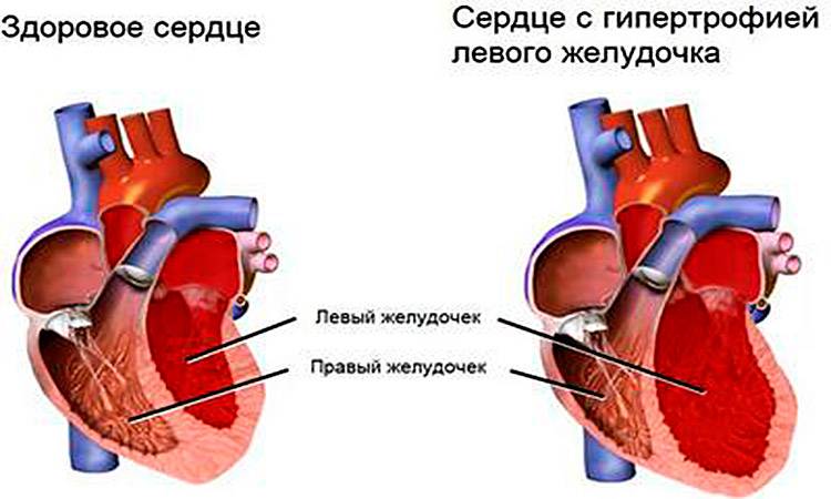 Гипертрофия левого желудочка