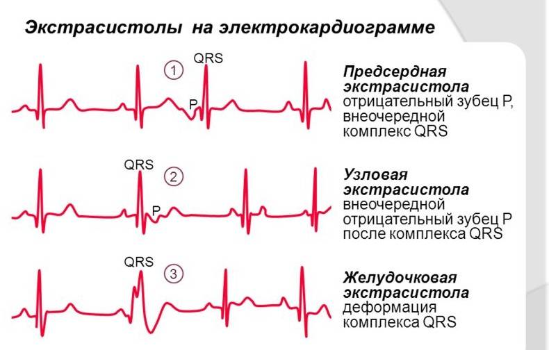 Экстрасистолы на ЭКГ