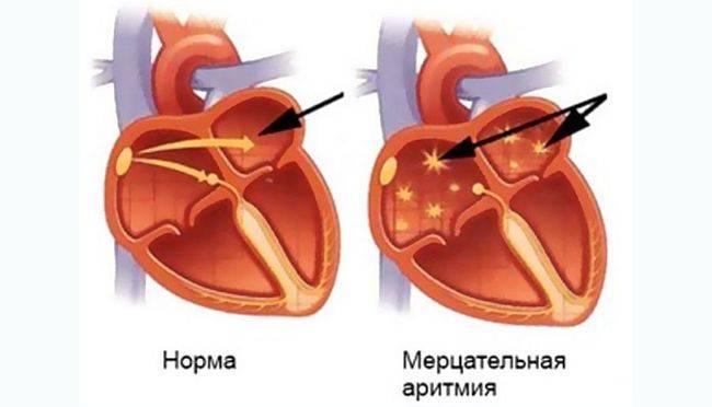 Мерцательная аритмия - одно из самых часто встречающихся явлений нарушения ритма сердца Мерцательная аритмия - одно из самых часто встречающихся явлений нарушения ритма сердца