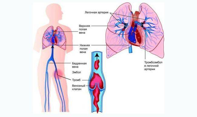 Большую опасность представляет значительный рост риска закупорки вен тромбами, которые могут попасть в циркулирующую кровь Большую опасность представляет значительный рост риска закупорки вен тромбами, которые могут попасть в циркулирующую кровь