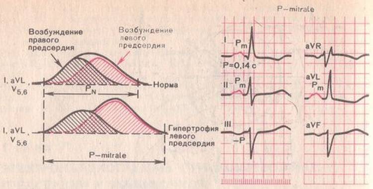ЭКГ-признаки увеличения размеров