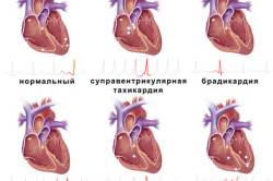 Ритмы сердца при разных заболеваниях