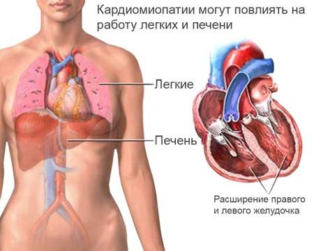 Гипертрофическая кардиомиопатия симптомы