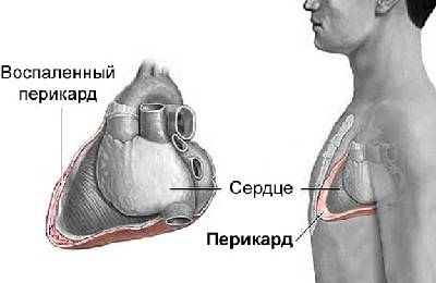 Перикардит