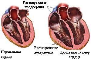 Дилатационная кардиомиопатия